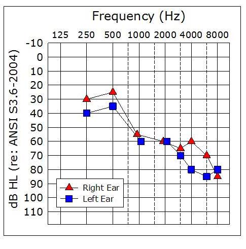 Audiometry Screening and Interpretation