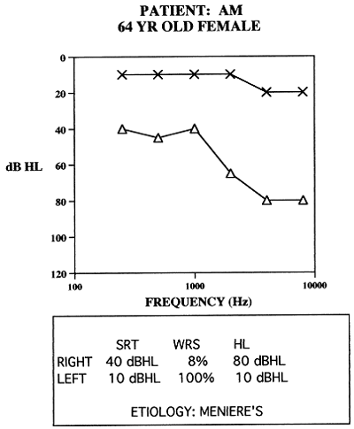 Asymmetrical Sensorineural Hearing Loss: Fitting Strategies Donald J ...